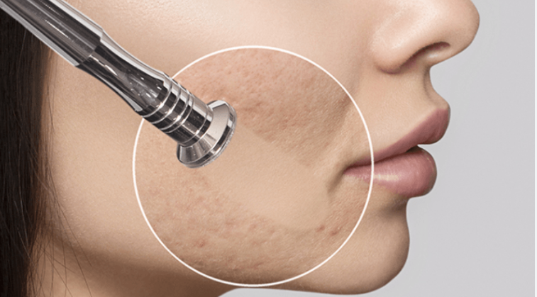 what_is_microdermabrasion   